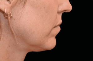 jaw 1