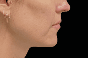 jaw 2